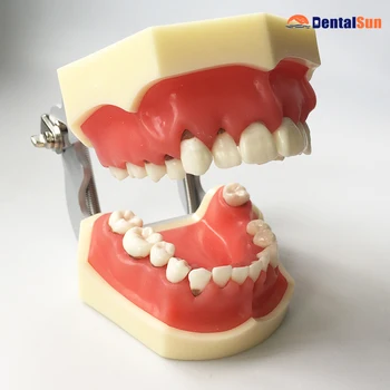 Dantų Periodonto Ligos Modelis M4024/Medicinos Dantų Medicininė Modelis