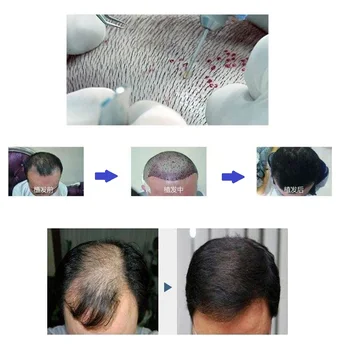 Fue Plaukų Transplantacijos Plaukų Folikulus Extractor Scarless Plaukų Retinimo ir Nuplikimas Gydymas Implantuoti Plaukų Priemonė